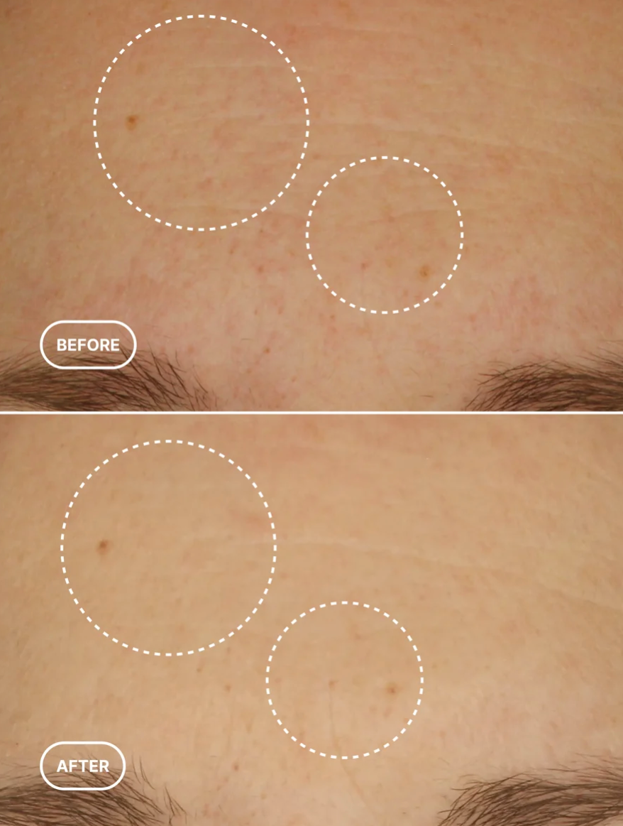 Before and after using Princess Mia Retinol Serum showing visibly smoother skin texture and improved appearance of fine lines and uneven skin tone.