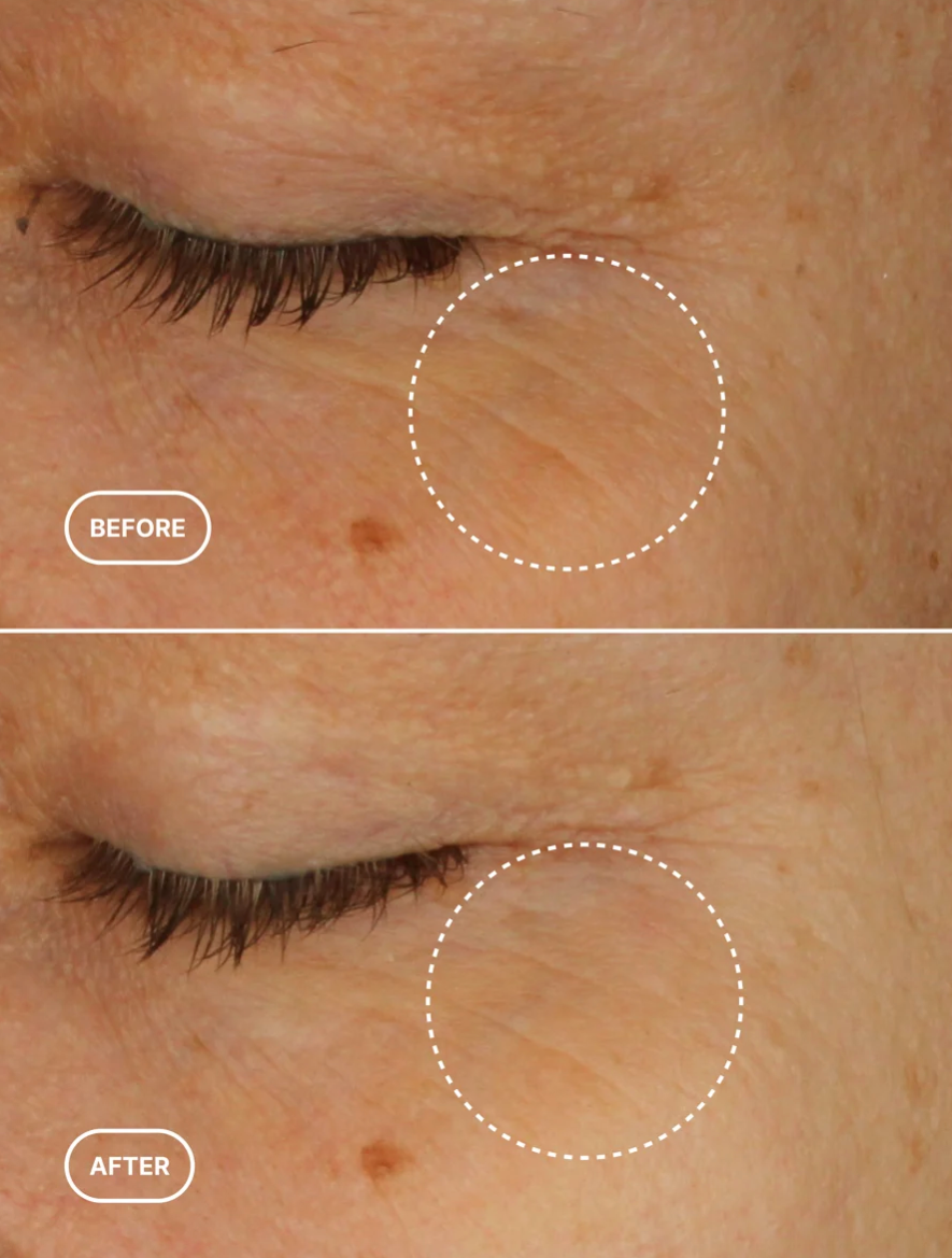 Before and after comparison showing visibly smoother-looking crow's feet after using Princess Mia Retinol Eye Serum with a natural retinol alternative and hydrating ingredients.